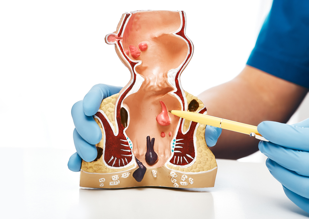 Close-up,,Rectum,Pathologies,On,An,Anatomical,Model.,Treatment,Of,Rectal