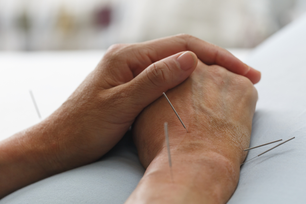 The,Patient,Had,A,Lot,Of,Acupuncture,On,His,Hand
